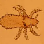 Infestazione pidocchi