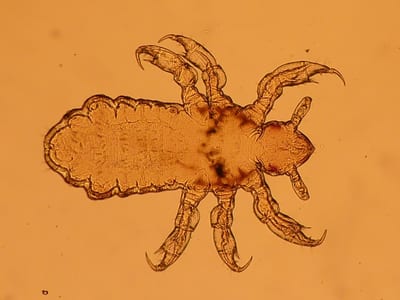 Infestazione pidocchi